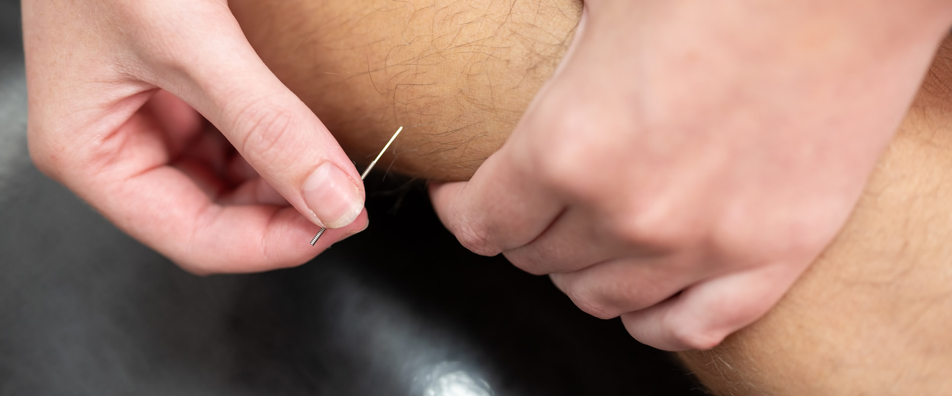 Acupuncture and pain relief treatment at Brookwood Physio